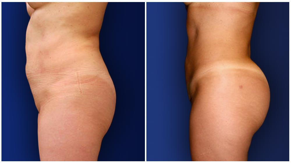 Brazilian Butt Lift - female patient (31 years) before and after