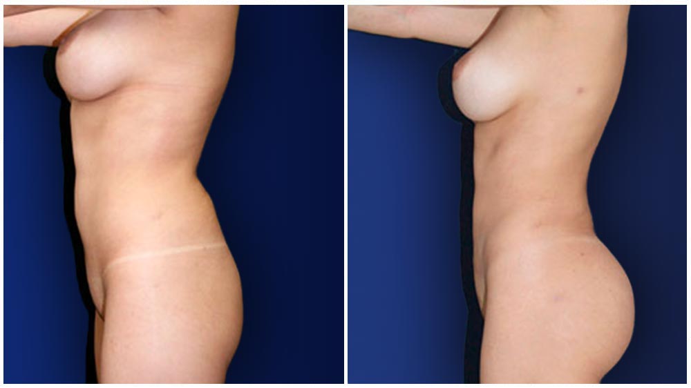 Cleveland Liposuction Specialty Clinic -  Fat Transfer to Buttocks Patient