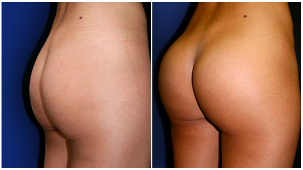 Differences in Volume - of a Brazilian Butt Lift Augmentation Patient