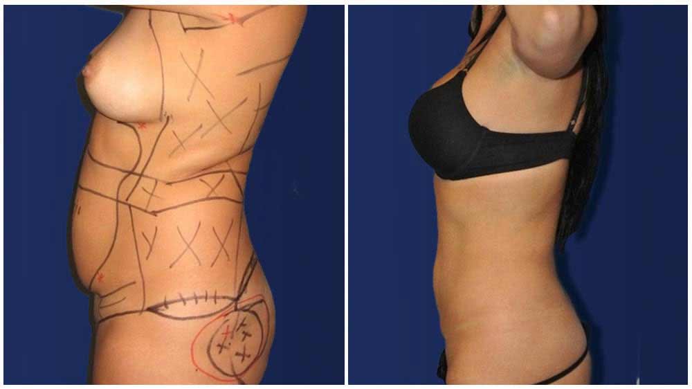 Fat Transfer of a Cleveland Liposuction Specialty Clinic Female Patient - (30 years)